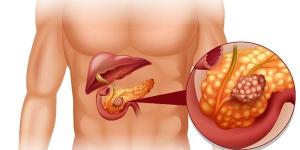 دراسة تكشف تأثير" فيتامين c" في تعزيز نتائج علاجات سرطان البنكرياس